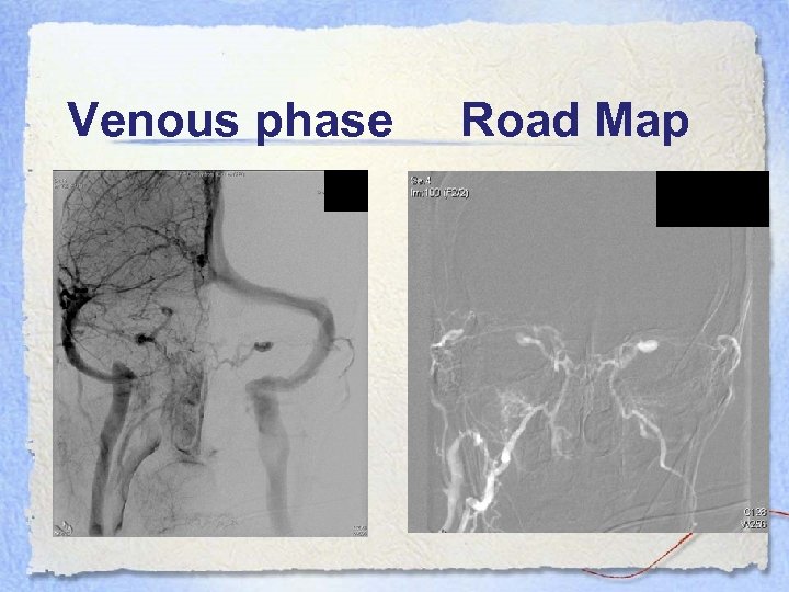 Venous phase Road Map 