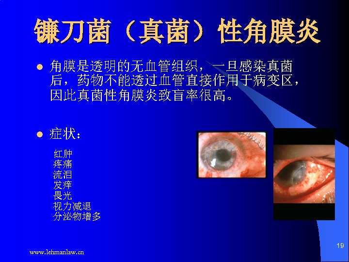 镰刀菌（真菌）性角膜炎 角膜是透明的无血管组织，一旦感染真菌 后，药物不能透过血管直接作用于病变区， 因此真菌性角膜炎致盲率很高。 l l 症状： 红肿 疼痛 流泪 发痒 畏光 视力减退 分泌物增多