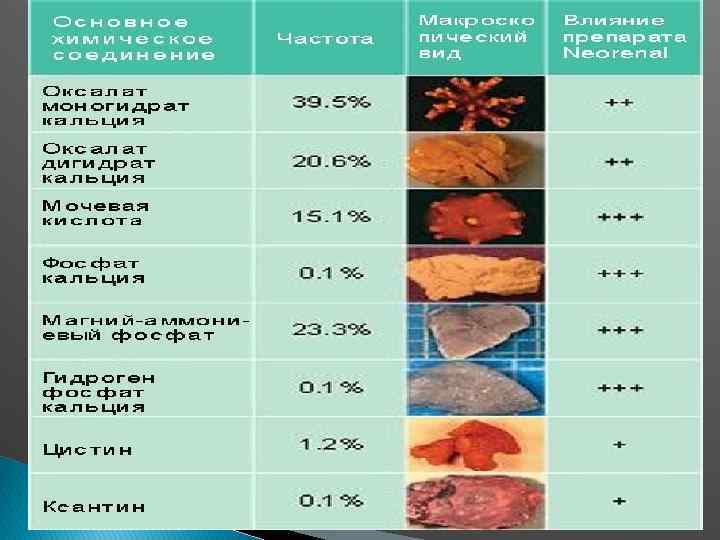 Типы камней в почках фото и описание