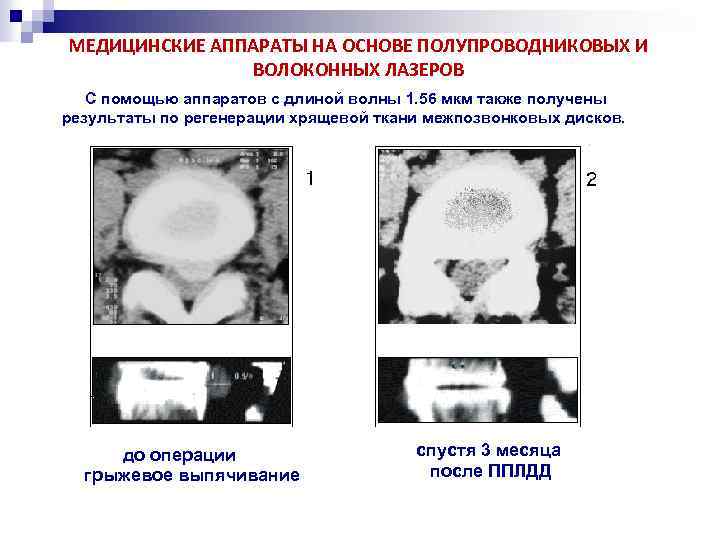 МЕДИЦИНСКИЕ АППАРАТЫ НА ОСНОВЕ ПОЛУПРОВОДНИКОВЫХ И ВОЛОКОННЫХ ЛАЗЕРОВ С помощью аппаратов с длиной волны