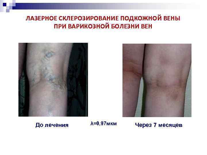 ЛАЗЕРНОЕ СКЛЕРОЗИРОВАНИЕ ПОДКОЖНОЙ ВЕНЫ ПРИ ВАРИКОЗНОЙ БОЛЕЗНИ ВЕН До лечения λ=0, 97 мкм Через