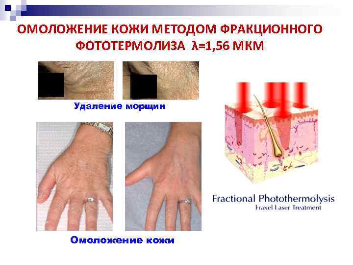 ОМОЛОЖЕНИЕ КОЖИ МЕТОДОМ ФРАКЦИОННОГО ФОТОТЕРМОЛИЗА λ=1, 56 МКМ Удаление морщин Омоложение кожи 