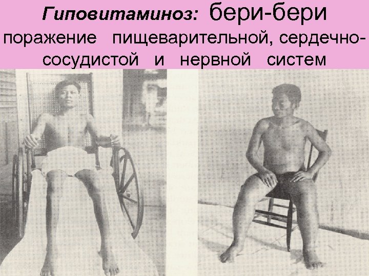 Гиповитаминоз: бери-бери поражение пищеварительной, сердечнососудистой и нервной систем 