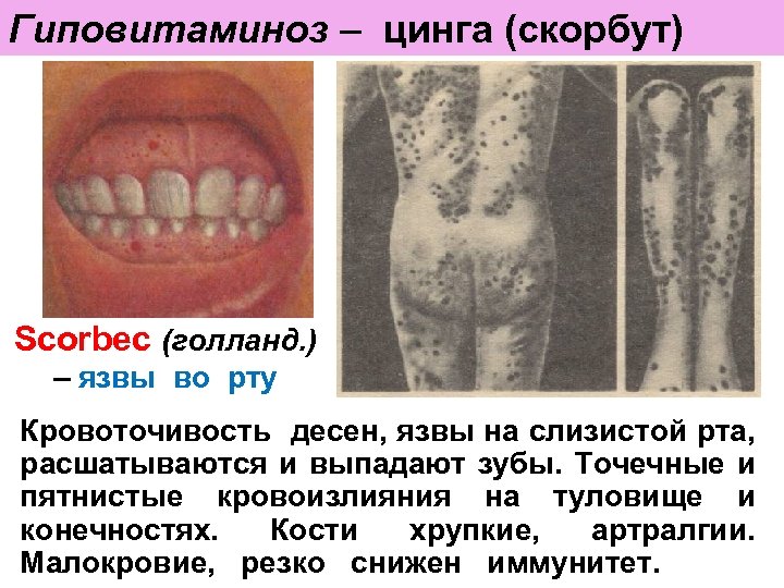 Гиповитаминоз – цинга (скорбут) Scorbec (голланд. ) – язвы во рту Кровоточивость десен, язвы