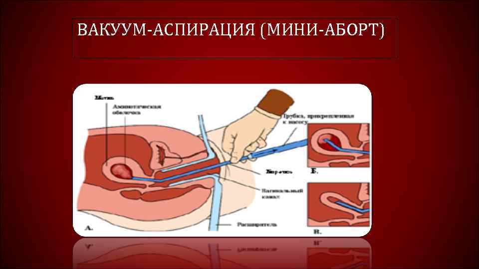 ВАКУУМ-АСПИРАЦИЯ (МИНИ-АБОРТ) 