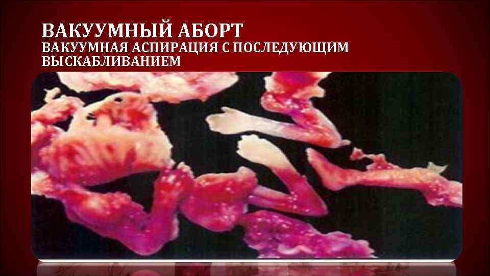 ВАКУУМНЫЙ АБОРТ ВАКУУМНАЯ АСПИРАЦИЯ С ПОСЛЕДУЮЩИМ ВЫСКАБЛИВАНИЕМ 