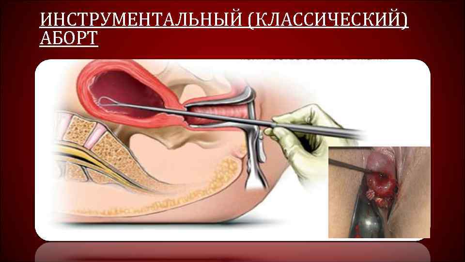 ИНСТРУМЕНТАЛЬНЫЙ (КЛАССИЧЕСКИЙ) АБОРТ 