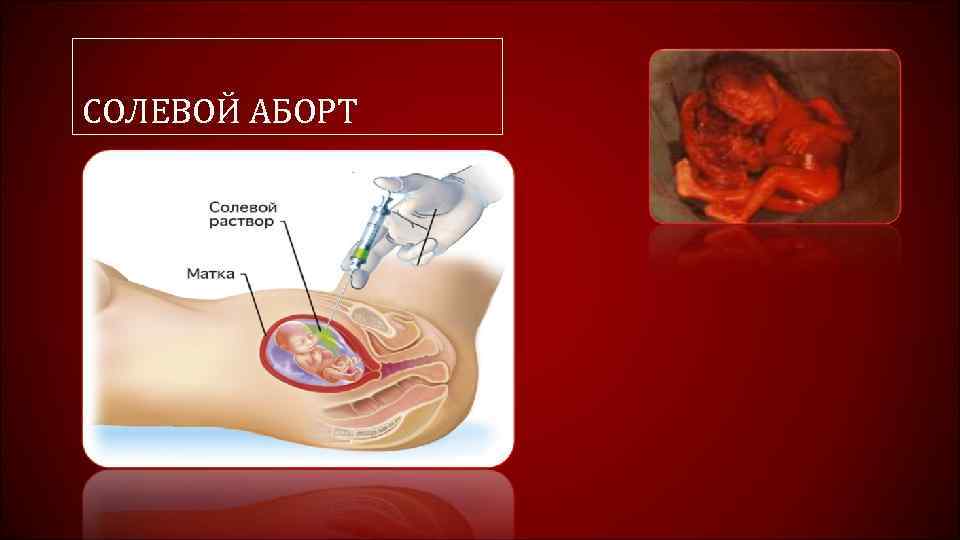СОЛЕВОЙ АБОРТ 