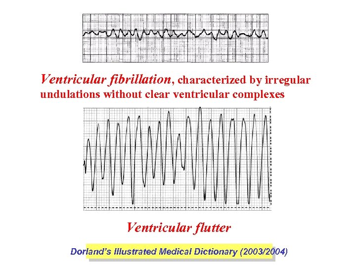 Ventricular fibrillation, characterized by irregular undulations without clear ventricular complexes Ventricular flutter Dorland’s Illustrated