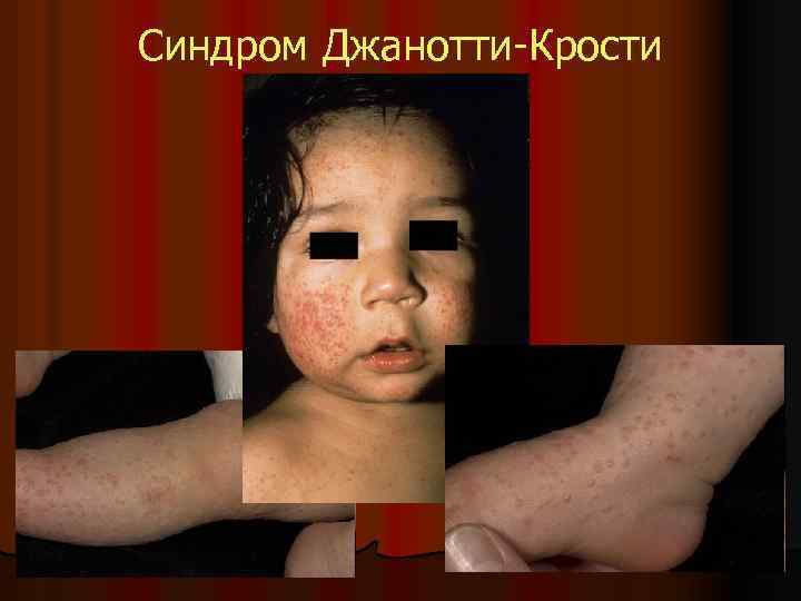 Синдром Джанотти-Крости 