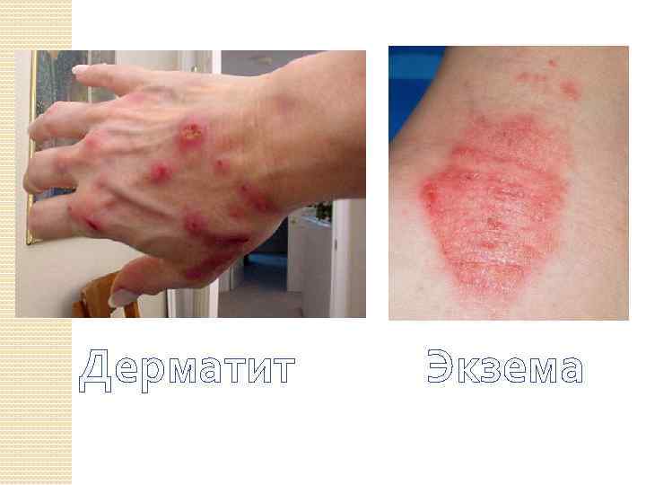 Дерматит Экзема 