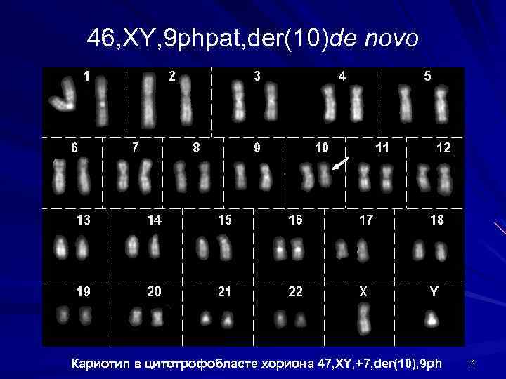 Кариотип 46 хх. 46,XY нормальный мужской кариотип. Мужской кариотип 46 XY. Кариотип 46 XY GH-.