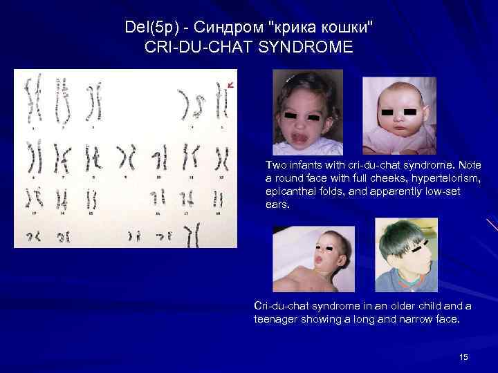 Del(5 p) - Синдром "крика кошки" CRI-DU-CHAT SYNDROME Two infants with cri-du-chat syndrome. Note