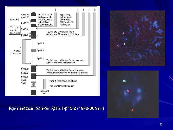 Критический регион 5 р15. 1 -р15. 2 (1970 -80 е гг. ) 17 