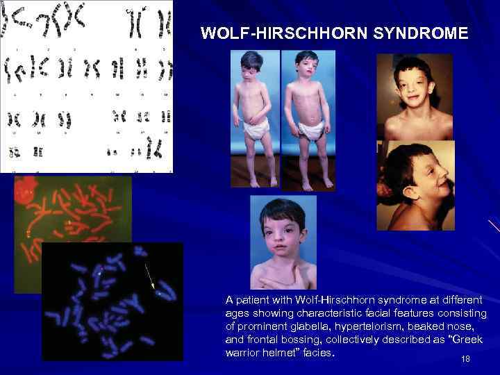WOLF-HIRSCHHORN SYNDROME A patient with Wolf-Hirschhorn syndrome at different ages showing characteristic facial features