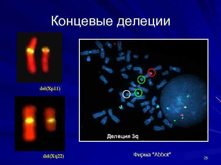 Концевые делеции del(Xp 11) Делеция 3 q del(Xq 22) Фирма "Abbot" 25 