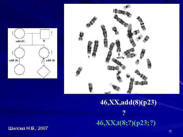Шилова Н. В. , 2007 46, XX, add(8)(p 23) ? 46, XX, t(8; ?
