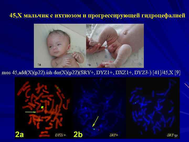45, Х мальчик с ихтиозом и прогрессирующей гидроцефалией mos 45, add(X)(p 22). ish der(X)(p
