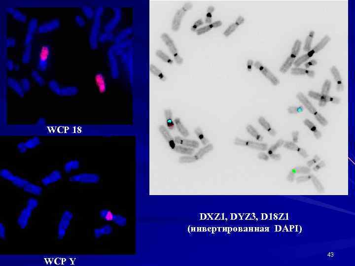 WCP 18 DXZ 1, DYZ 3, D 18 Z 1 (инвертированная DAPI) WCP Y