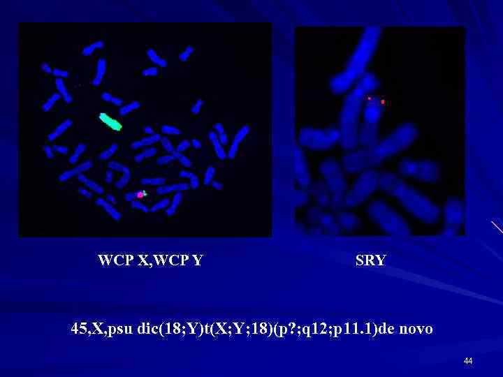 WCP X, WCP Y SRY 45, X, psu dic(18; Y)t(X; Y; 18)(p? ; q