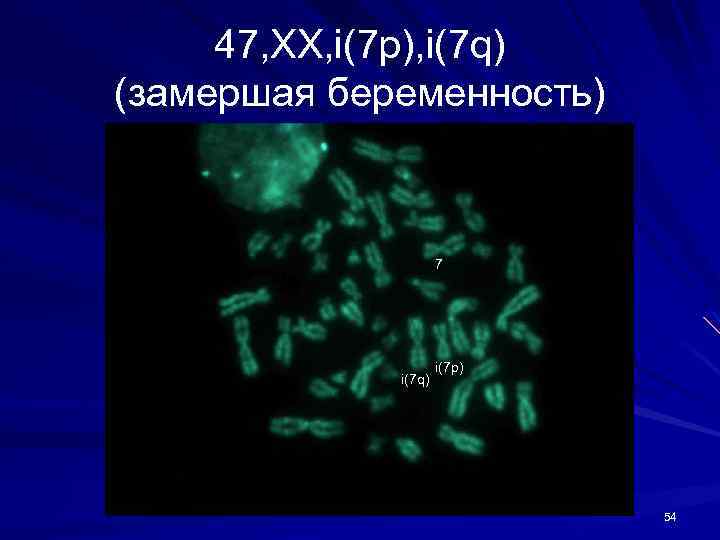 47, ХХ, i(7 p), i(7 q) (замершая беременность) 7 i(7 q) i(7 p) 54