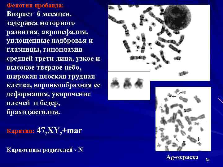Фенотип пробанда: Возраст 6 месяцев, задержка моторного развития, акроцефалия, уплощенные надбровья и глазницы, гипоплазия