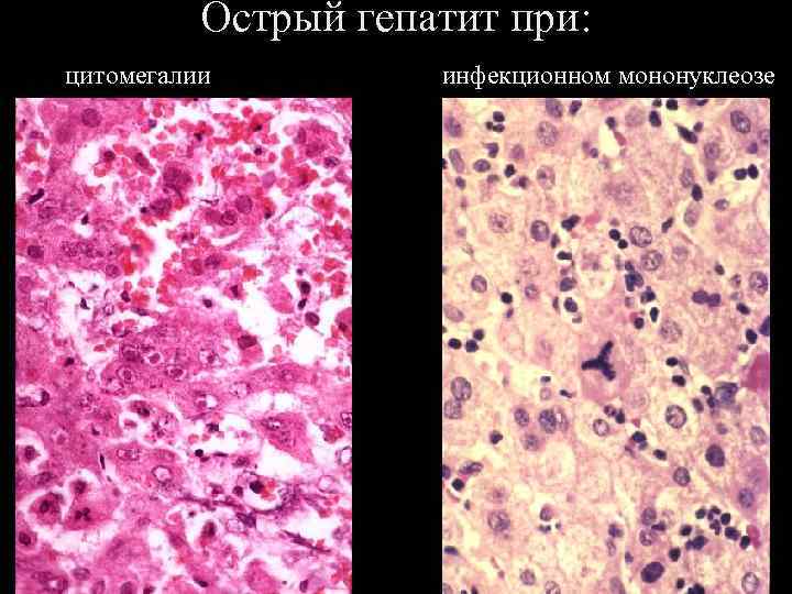 Острый гепатит при: цитомегалии 06. 02. 2018 инфекционном мононуклеозе 