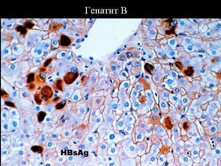 Гепатит В 06. 02. 2018 