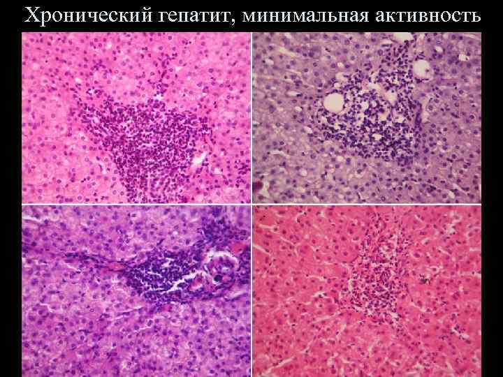 Хронический гепатит, минимальная активность 06. 02. 2018 