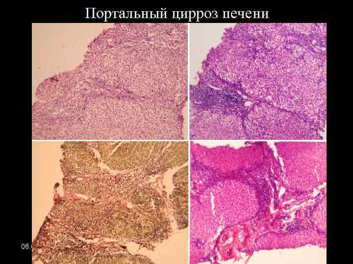 Портальный цирроз печени 06. 02. 2018 