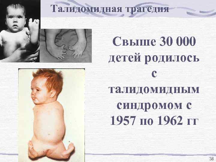 Талидомидная трагедия Свыше 30 000 детей родилось с талидомидным синдромом с 1957 по 1962