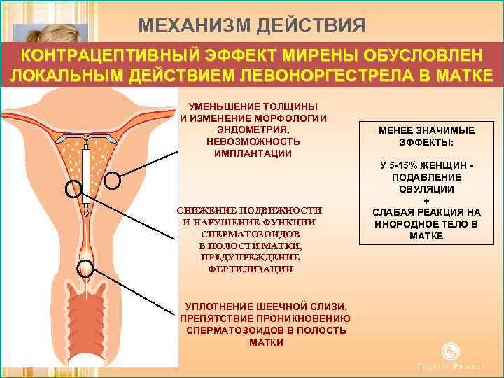 МЕХАНИЗМ ДЕЙСТВИЯ КОНТРАЦЕПТИВНЫЙ ЭФФЕКТ МИРЕНЫ ОБУСЛОВЛЕН ЛОКАЛЬНЫМ ДЕЙСТВИЕМ ЛЕВОНОРГЕСТРЕЛА В МАТКЕ УМЕНЬШЕНИЕ ТОЛЩИНЫ И