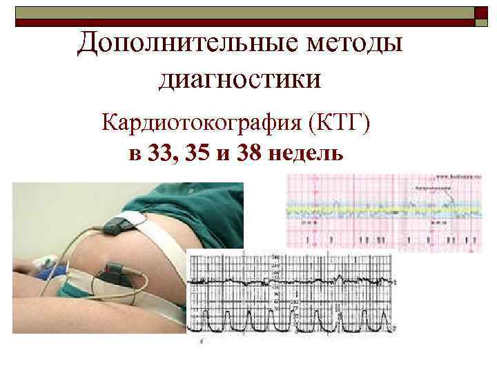 Дополнительные методы диагностики Кардиотокография (КТГ) в 33, 35 и 38 недель 