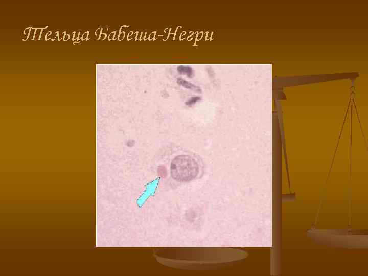 Тельца Бабеша-Негри 