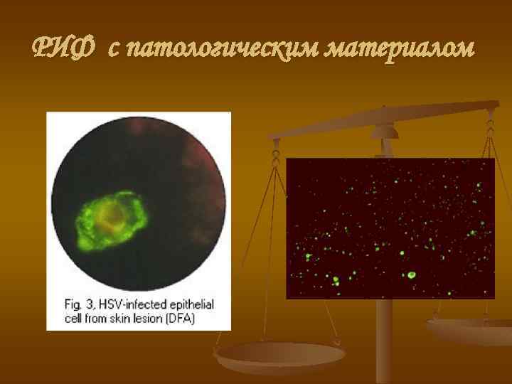 РИФ с патологическим материалом 