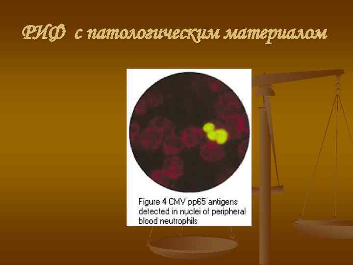 РИФ с патологическим материалом 