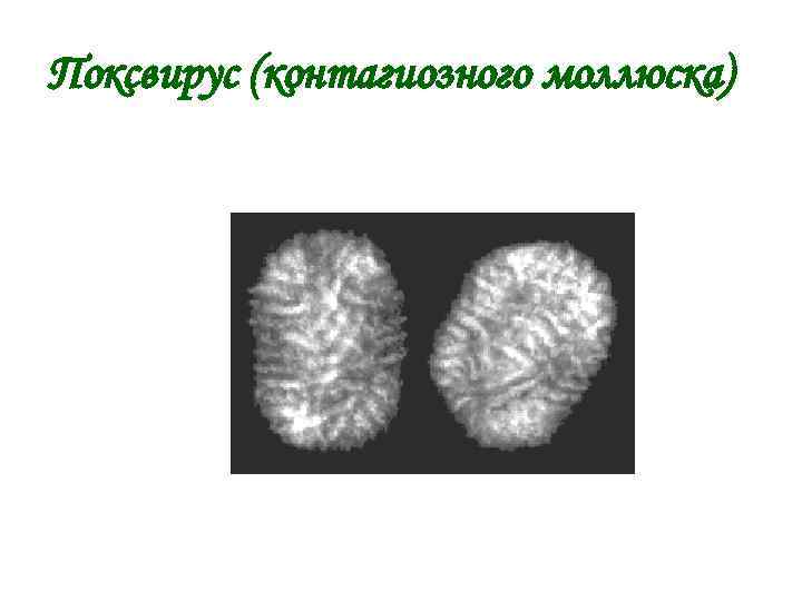 Поксвирус (контагиозного моллюска) 