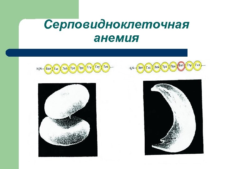 Серповидноклеточная анемия 