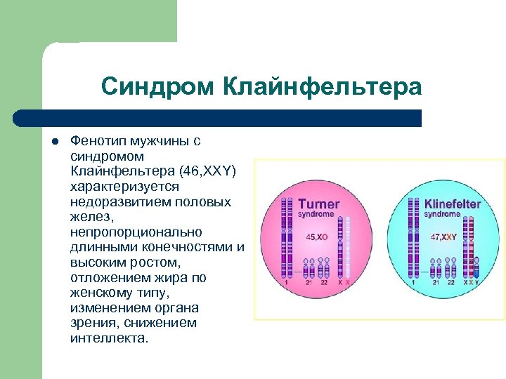 Синдром Клайнфельтера l Фенотип мужчины с синдромом Клайнфельтера (46, ХХY) характеризуется недоразвитием половых желез,
