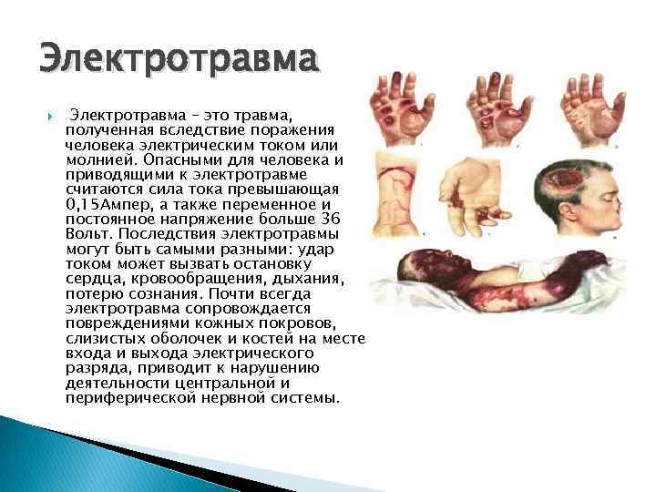Электротравма – это травма, полученная вследствие поражения человека электрическим током или молнией. Опасными для