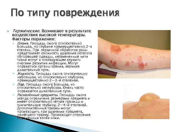 По типу повреждения Термические. Возникают в результате воздействия высокой температуры. Факторы поражения: ◦ Пламя.