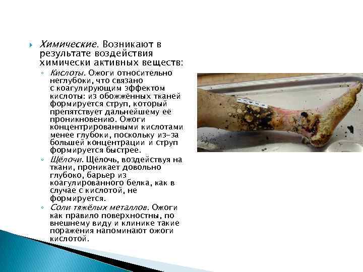  Химические. Возникают в результате воздействия химически активных веществ: ◦ Кислоты. Ожоги относительно неглубоки,