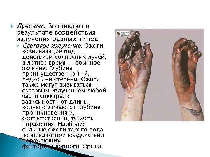  Лучевые. Возникают в результате воздействия излучения разных типов: ◦ Световое излучение. Ожоги, возникающие