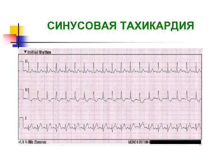 Синусовая тахикардия