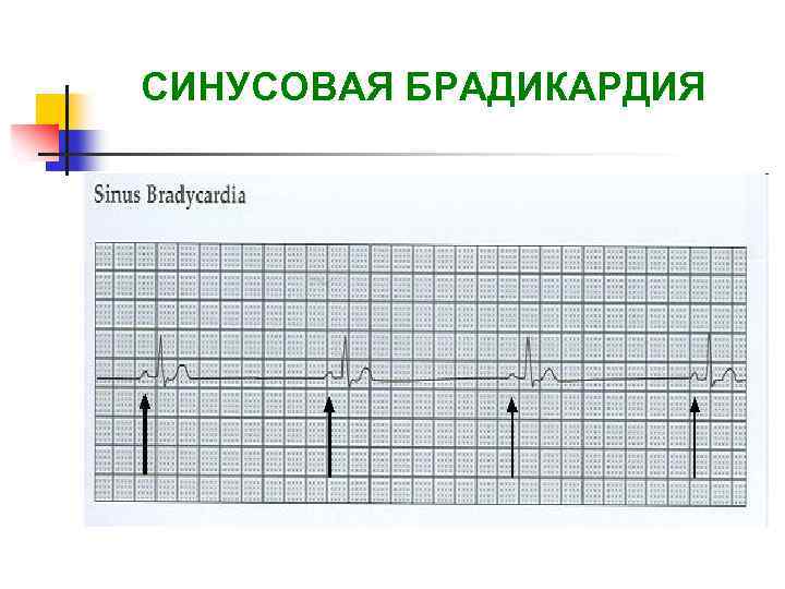 Синусовая брадикардия неполная