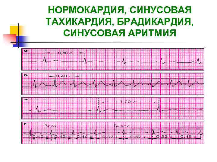 НОРМОКАРДИЯ, СИНУСОВАЯ ТАХИКАРДИЯ, БРАДИКАРДИЯ, СИНУСОВАЯ АРИТМИЯ 