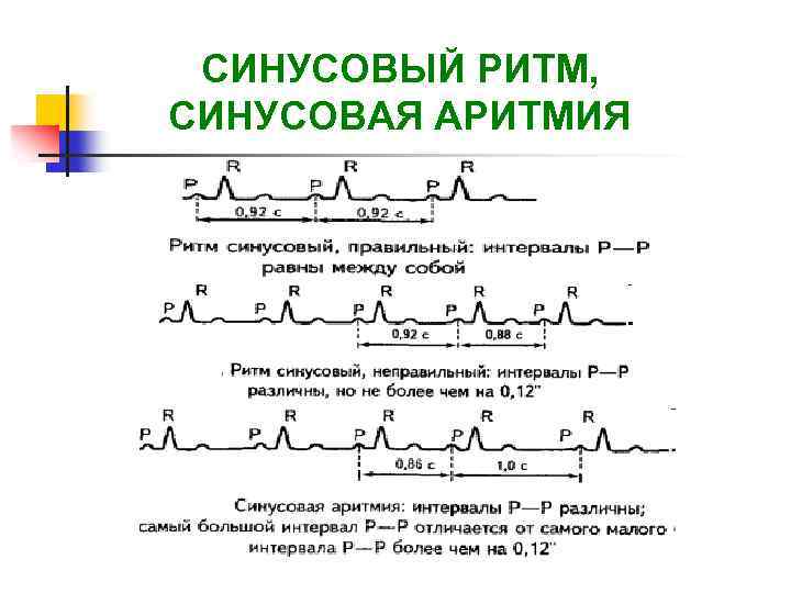 На фоне синусового ритма