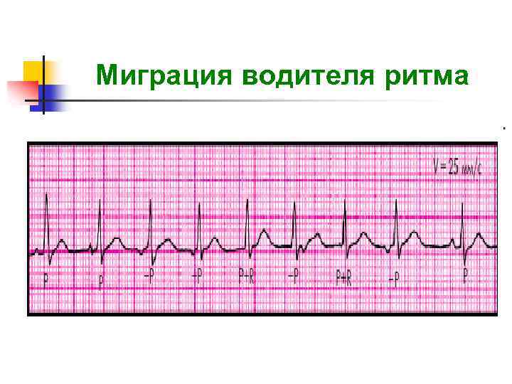 Аритмии презентация факультетская терапия