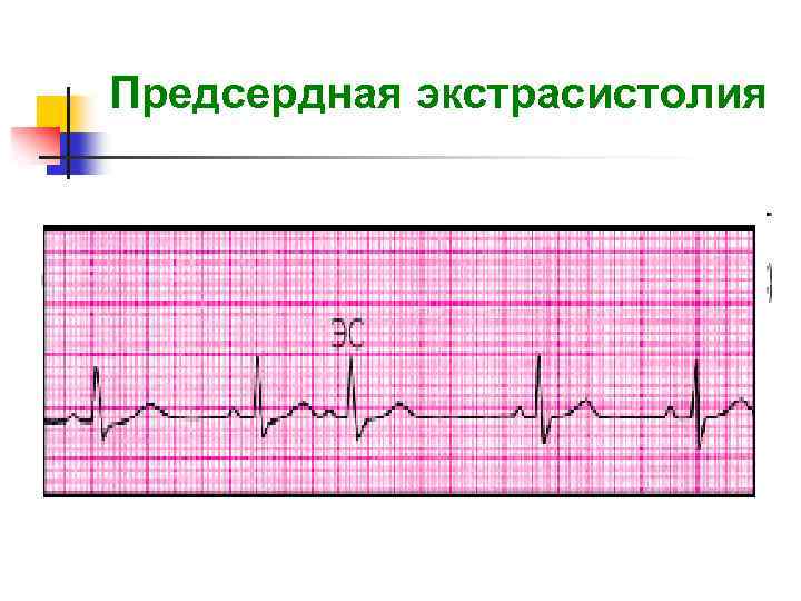Предсердные экстрасистолы. Предсердная экстрасистолия на ЭКГ. Предсердная экстрасистолия экстрасистолия ЭКГ. Нарушение ритма предсердная экстрасистолия. Предсердная экстрасистолия схема.