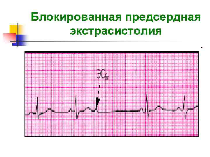 Блокированная предсердная экстрасистолия 